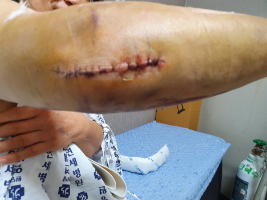 A씨는 원당연세의원에서 전치 8주의 오른팔 팔꿈치 골절 진단에 따라 접합수술을 받고 사흘 동안 입원해야만 했다.  사진 = 피해자 A씨 제공