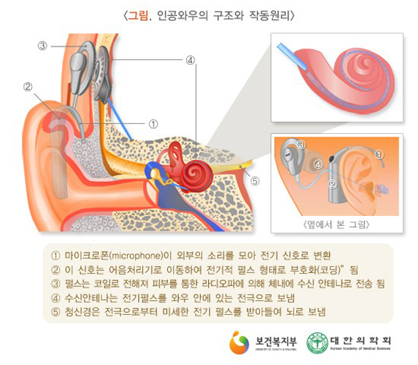 인광와우의 구조와 작동원리 [이미지 출처 = 국가건강정보포털 의학정보]