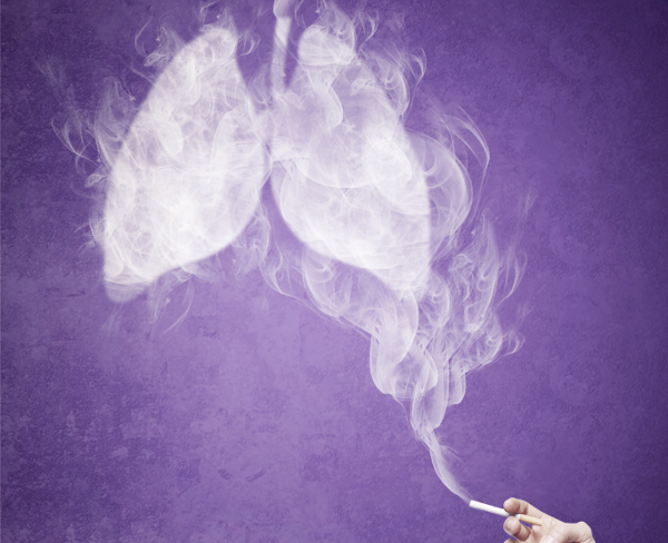 폐암의 약 85%가 흡연으로 인해 발생하는 것으로 보고되고 있다.