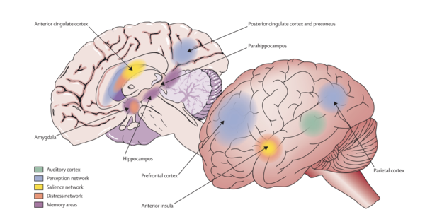 경두개자기장자극술(TMS) 치료로 회복가능한 이명 회로 예시. [자료제공=박병훈 교수]