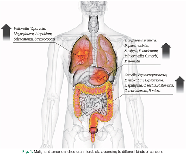 다양한 종류의 암 발생과 관련된 구강 유래 미생물 [이미지 제공 = 사과나무의료재단]