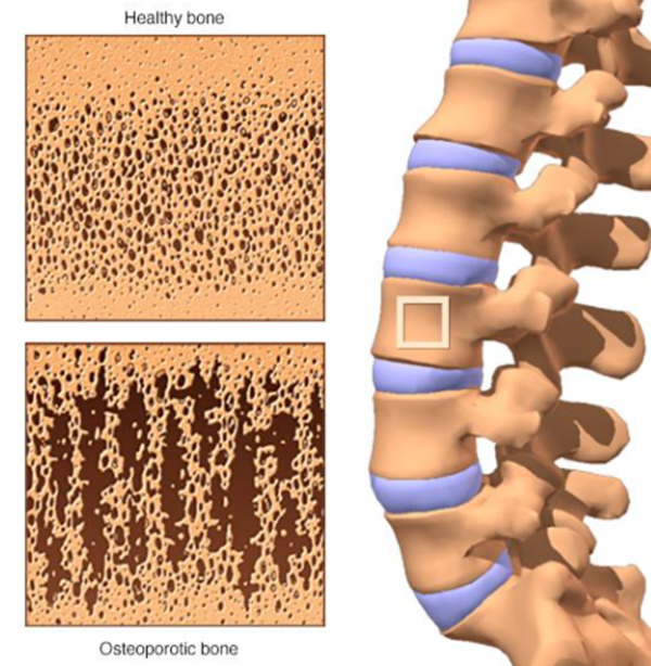 골다공증은 뼛속에서 촘촘하게 있던 기둥들이 얇아지면서 뼈가 약해지는 것.